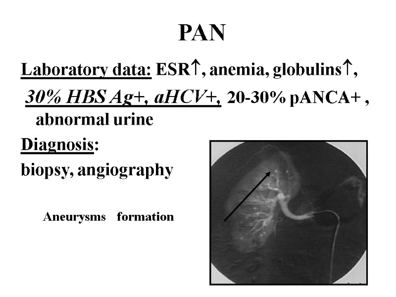 PAN Laboratory data: ESR, anemia, globulins,   30% HBS Ag+, aHCV+, 20-30% pANCA+